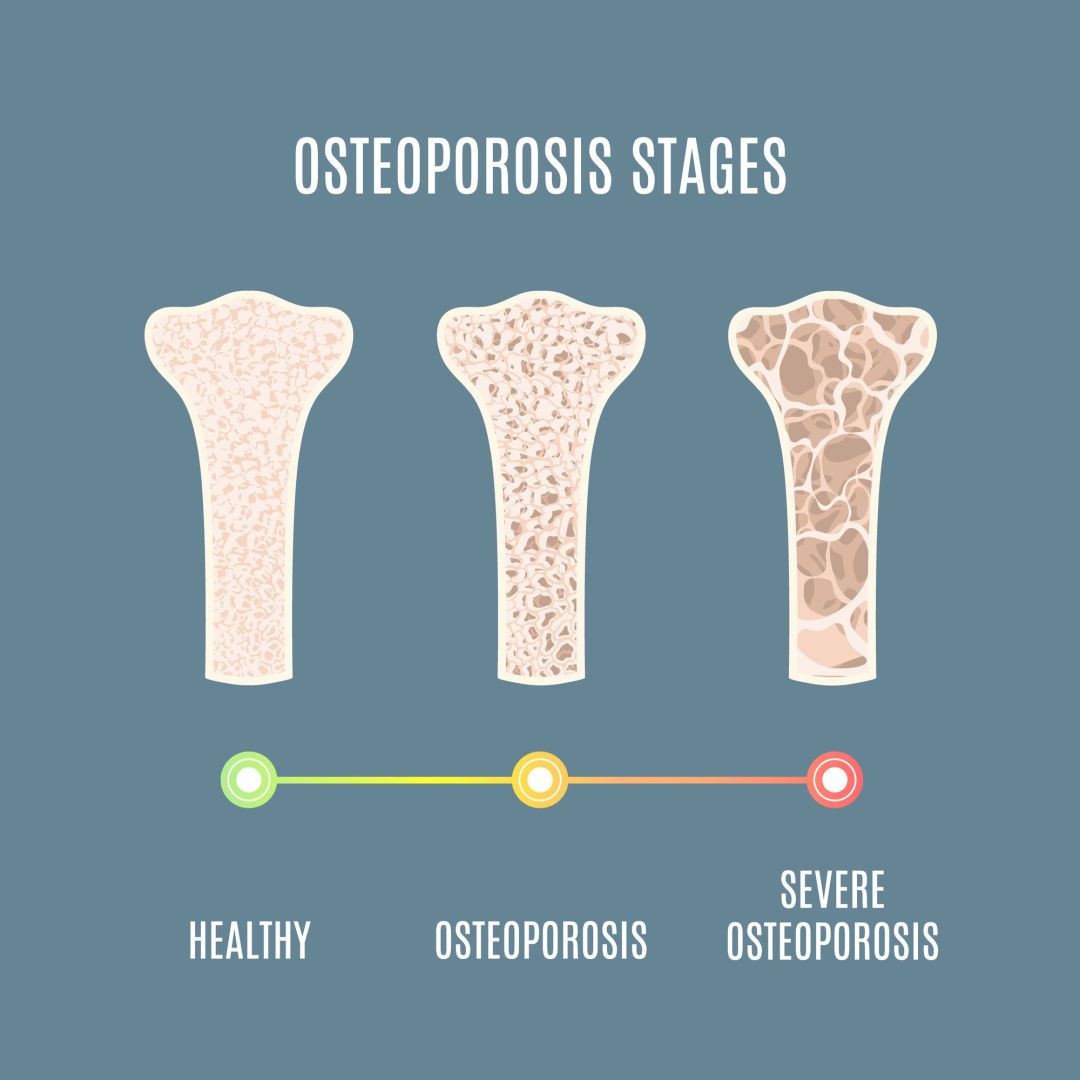 Osteoporosis Stages Blog